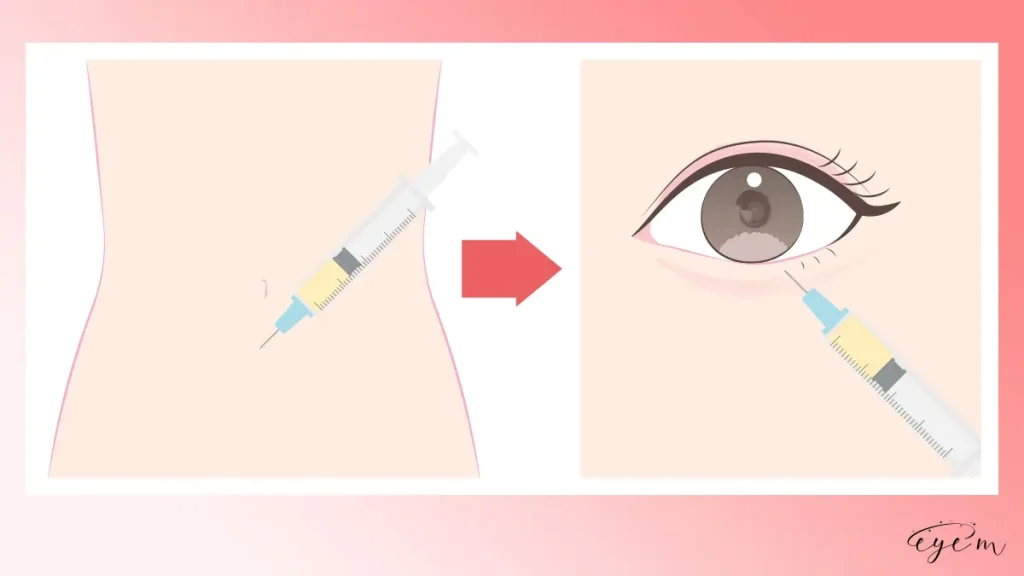 涙袋形成の脂肪注入とは
