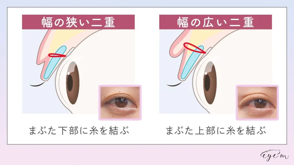 幅の狭い二重と広い二重の違い