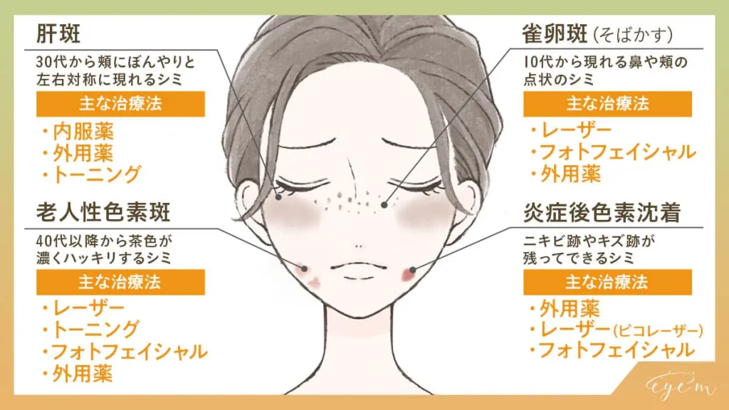 シミの種類と主な治療法