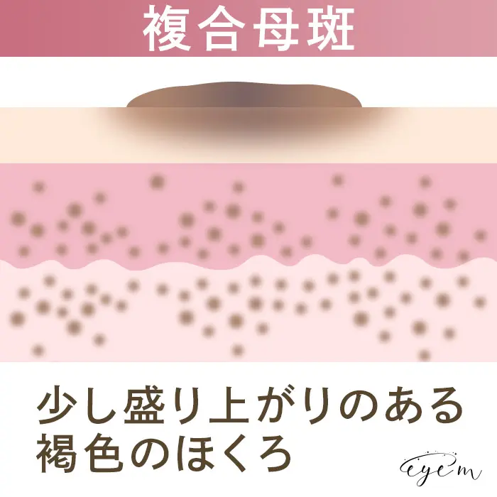 複合母斑は少し盛り上がりのある褐色のほくろ