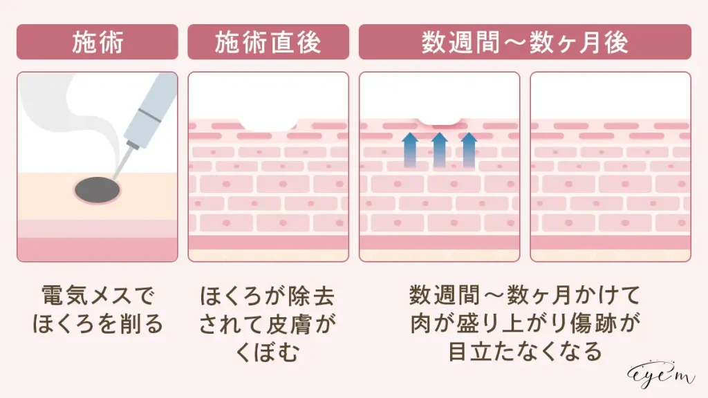 電気メスは施術後数週間から数ヶ月で傷跡が目立ちにくくなる