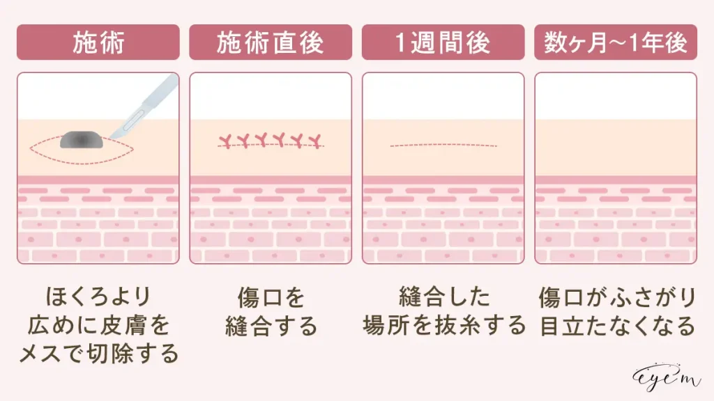 切開法は施術後数ヶ月から1年かけて傷跡が目立ちにくくなる