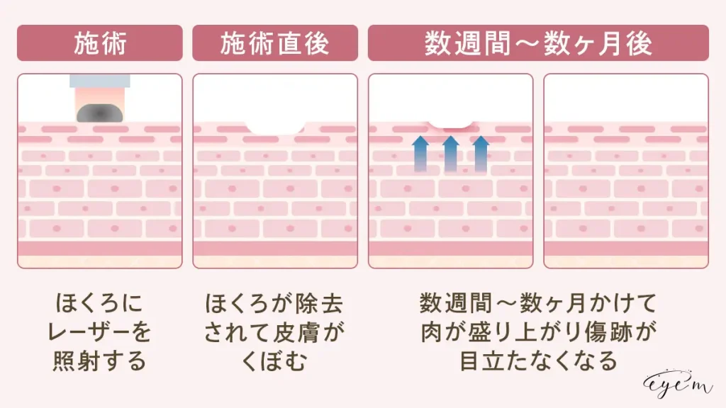 炭酸ガスレーザーは施術後数週間から数ヶ月で傷跡が目立ちにくくなる