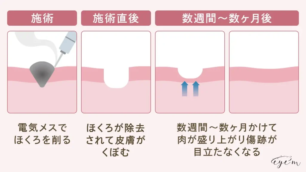 電気メスは施術後数週間から数ヶ月で傷跡が目立ちにくくなる