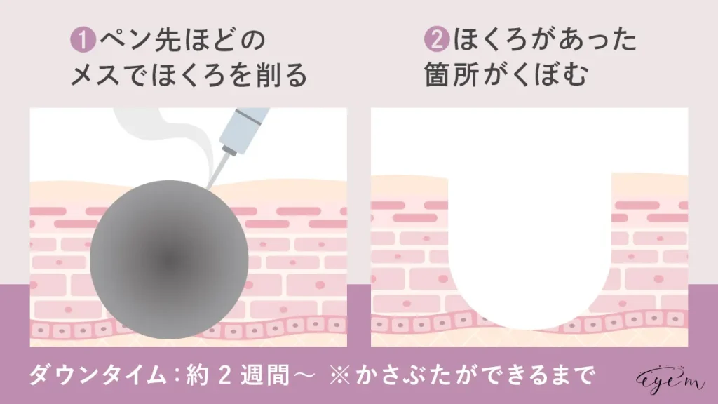 電気メスの治療法