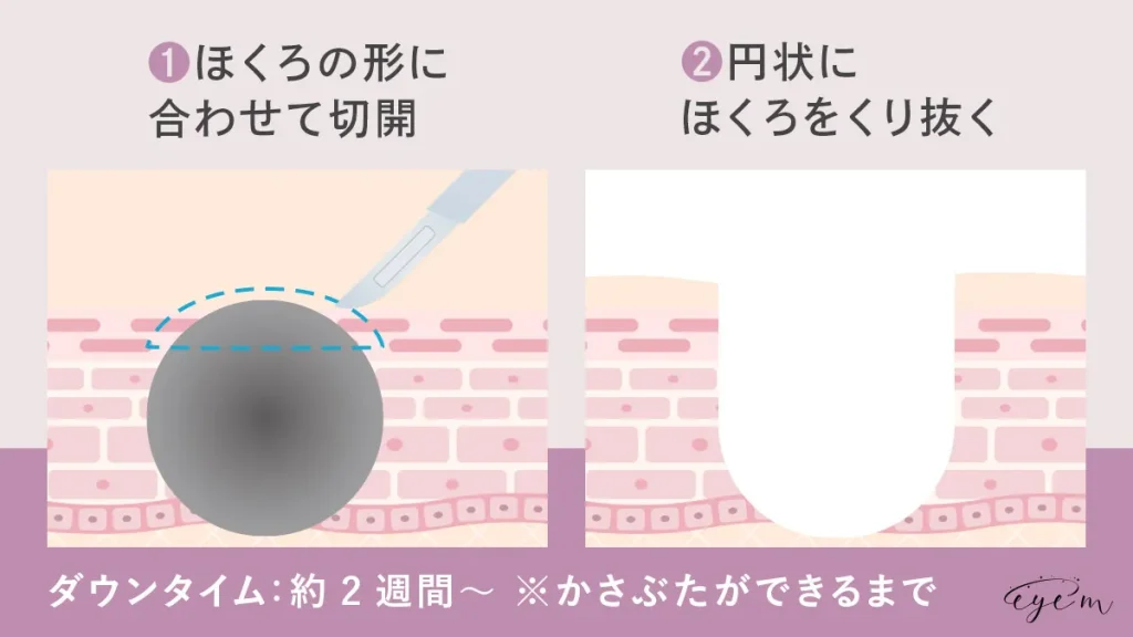 くり抜き法の治療法