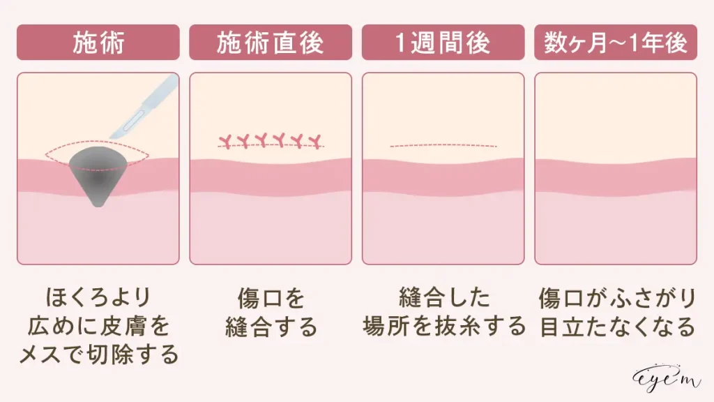 切除法は施術後数ヶ月から1年かけて傷跡が目立ちにくくなる