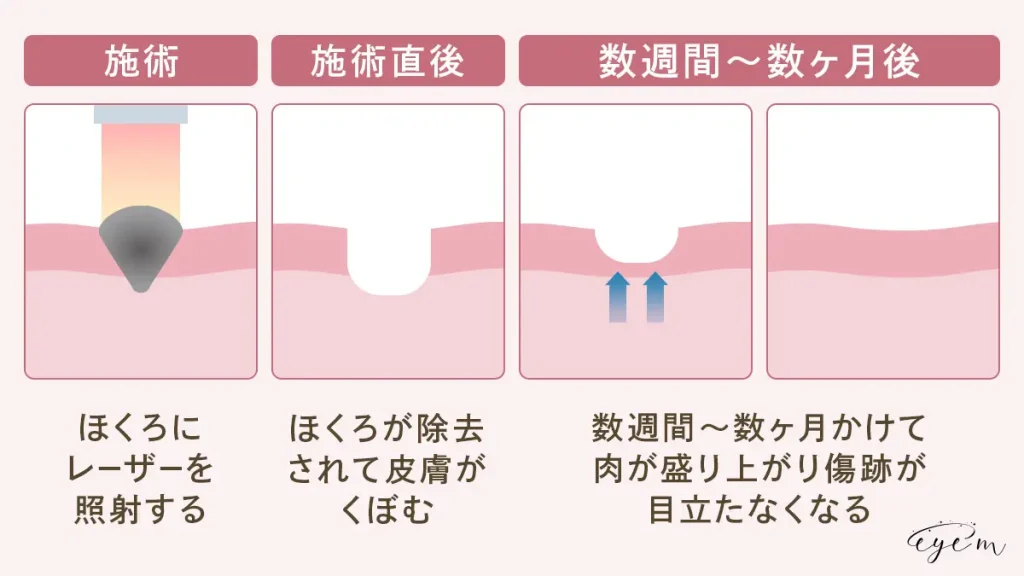 炭酸ガスレーザーは施術後数週間から数ヶ月で傷跡が目立ちにくくなる