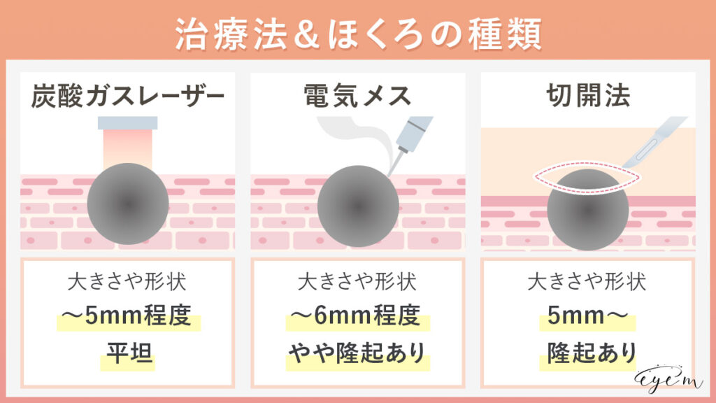 ほくろ除去の治療法について解説しているイラスト