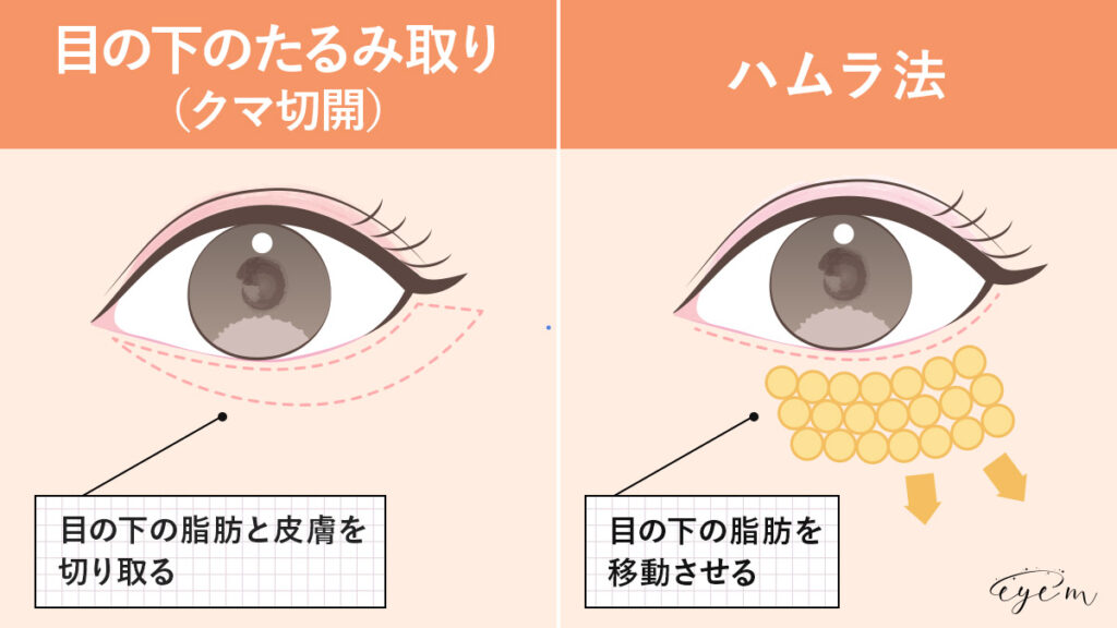 目の下のたるみ取り（クマ切開）とハムラ法の施術方法のイラスト