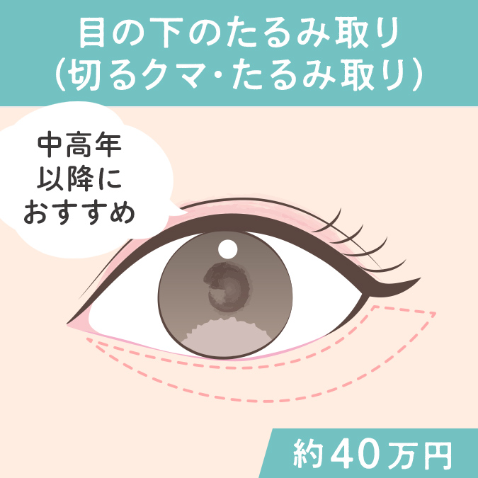 目の下のたるみ取り（切るクマ・たるみ取り）の施術方法