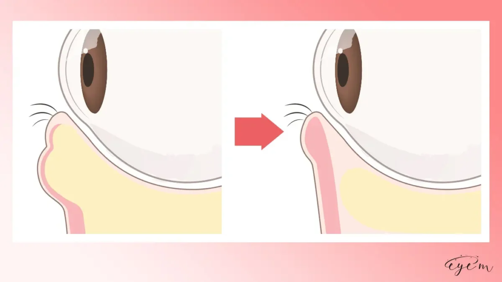 目の下の脂肪があって涙袋が出ていない目