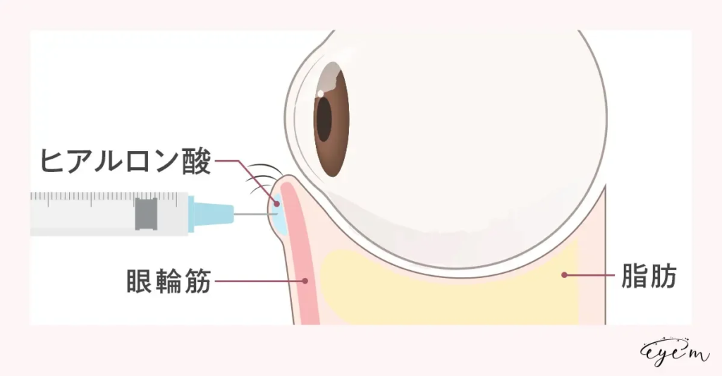 目元の構造と施術法を解説するイラスト