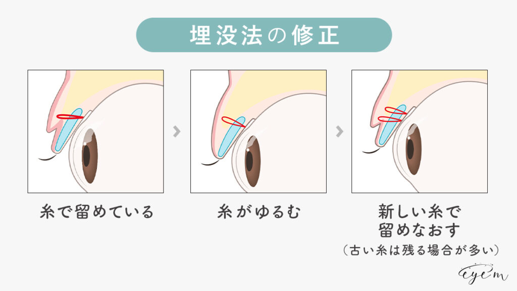 埋没法の修正法