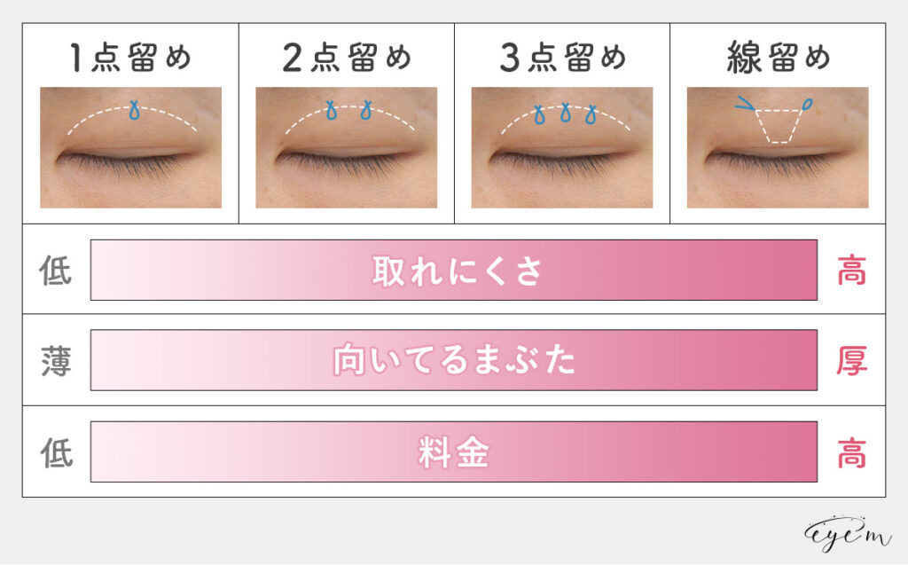 二重埋没の施術法ごとの特徴