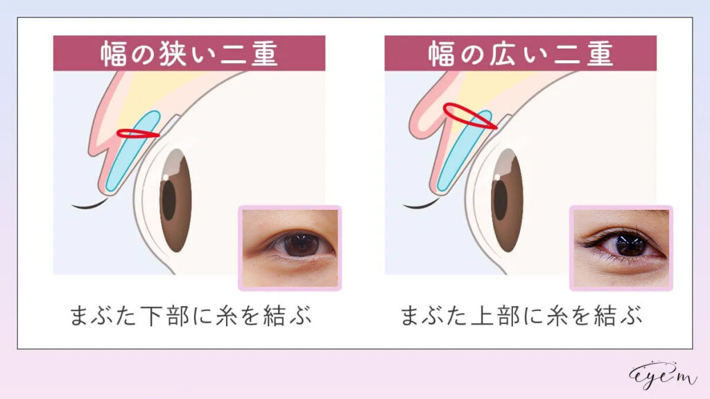 幅の狭い二重と幅の広い二重