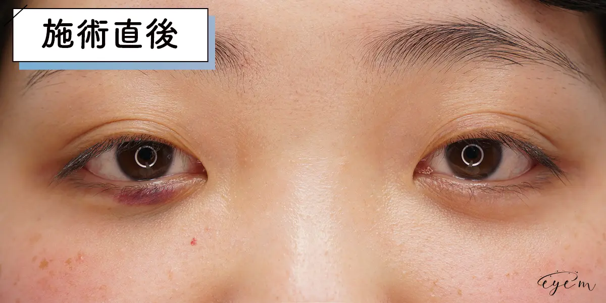 涙袋のヒアルロン酸はすぐなくなる 持続期間や持ちをよくする方法を徹底解説 Eye M アイム 目元専門の美容整形メディア